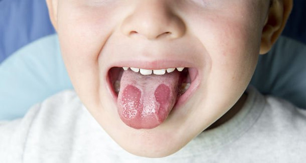 Bệnh nấm lưỡi ở trẻ
