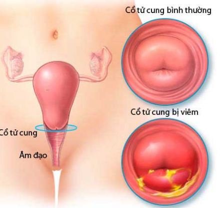 chi phí điều trị viêm cổ tử cung