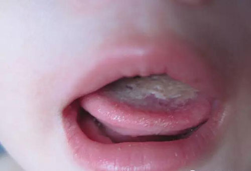 Trẻ bị nấm lưỡi